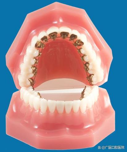 正畸颊面管的长度-图1 正畸颊面管的长度-图1