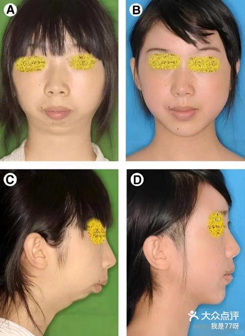 正畸改变下巴后缩-图3
