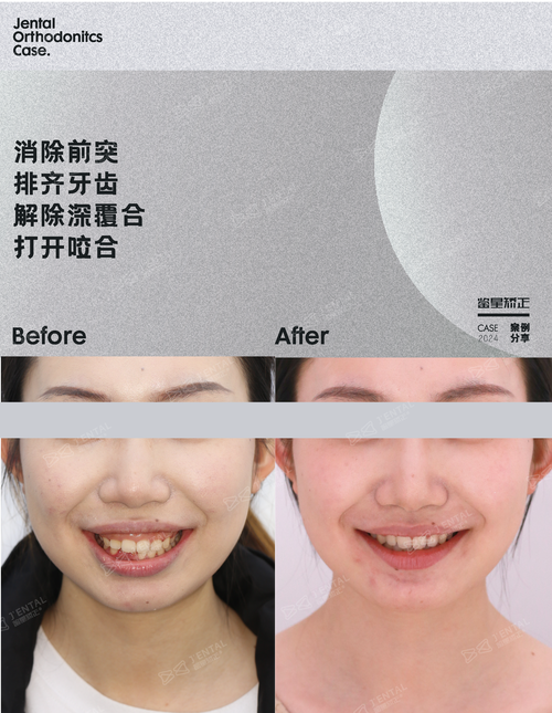 正畸后导致深覆合-图1