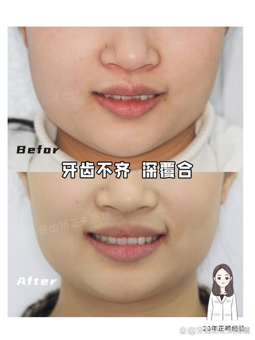 正畸后导致深覆合-图3