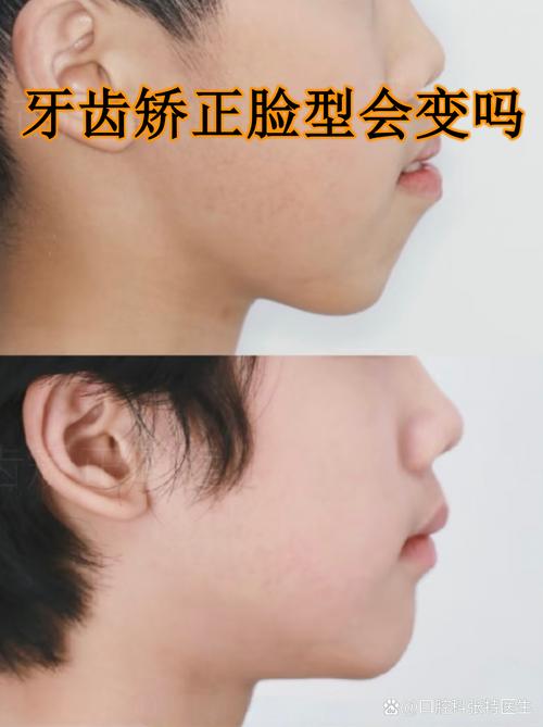 正畸对嘴巴的影响具体有哪些？-图1