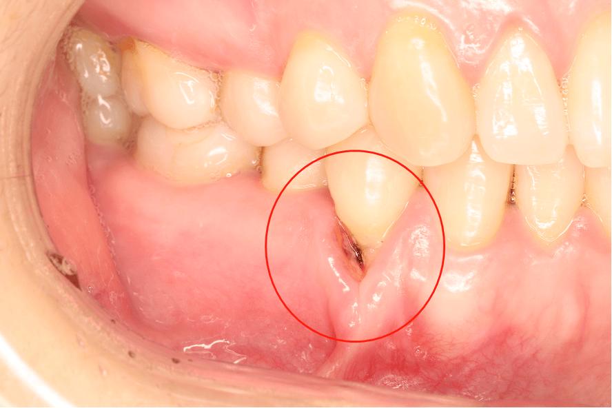 正畸后牙龈萎缩图示？原因、危害及应对方法有哪些？-图1