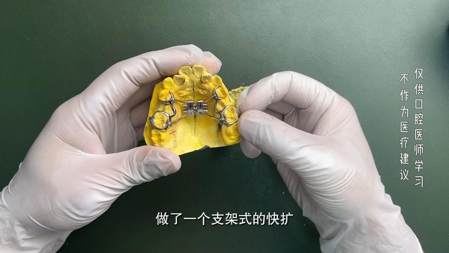 正畸 可摘矫治器-图2 正畸 可摘矫治器-图2