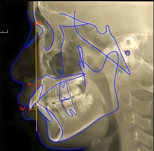 正畸面轴角的测量-图2