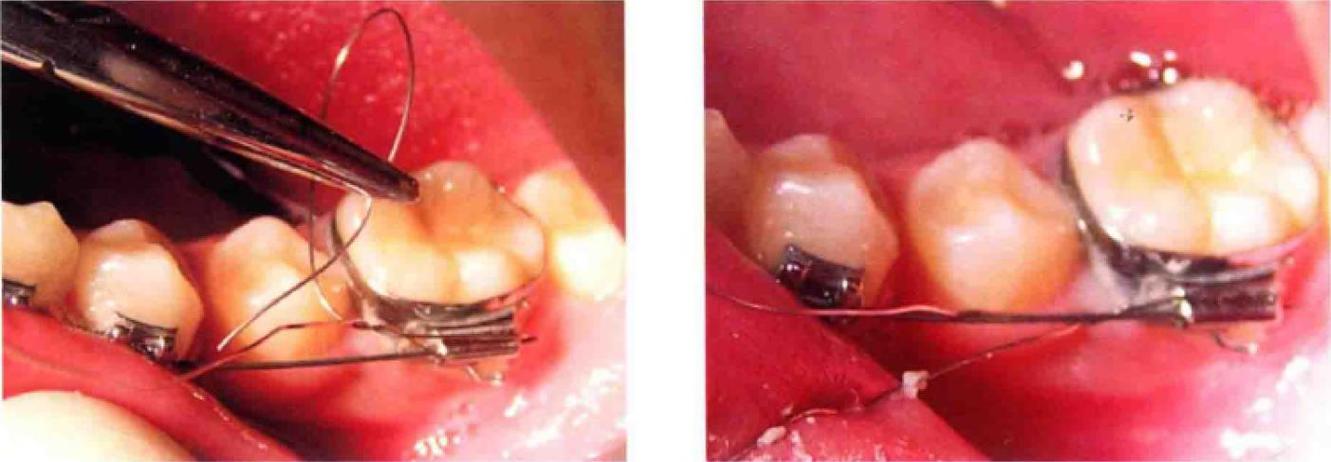 正畸结扎丝怎么绑-图3 正畸结扎丝怎么绑-图3