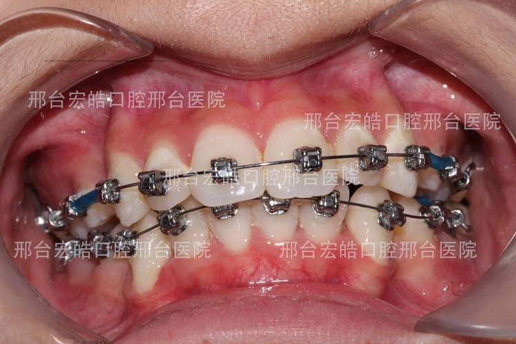 不想正颌手术正畸，不手术矫正可行吗？-图3