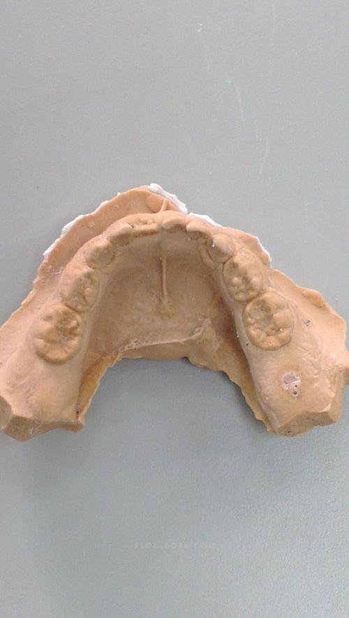 正畸咬合平面导板是什么？对咬合矫正有何作用？-图3