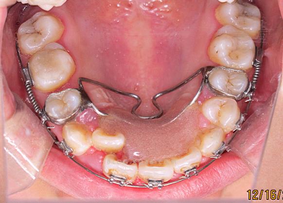 磨牙后推正畸过程是怎样的？步骤和效果如何？-图3