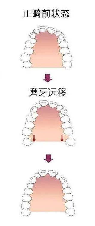 磨牙后推正畸过程是怎样的？步骤和效果如何？-图2