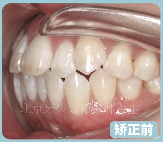 正畸尖牙中性关系-图2