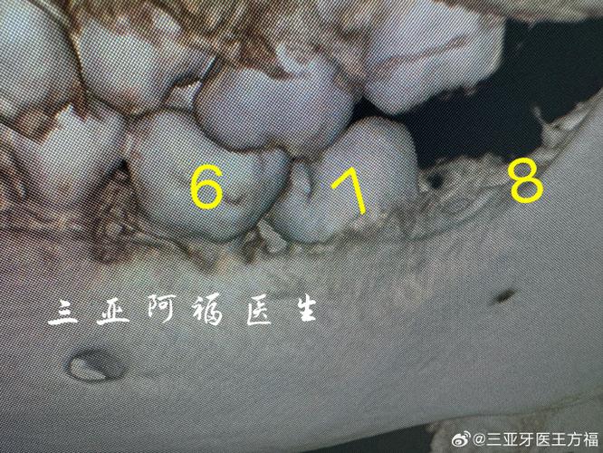 正畸牙矫正时，为何需要扶正智齿？-图3