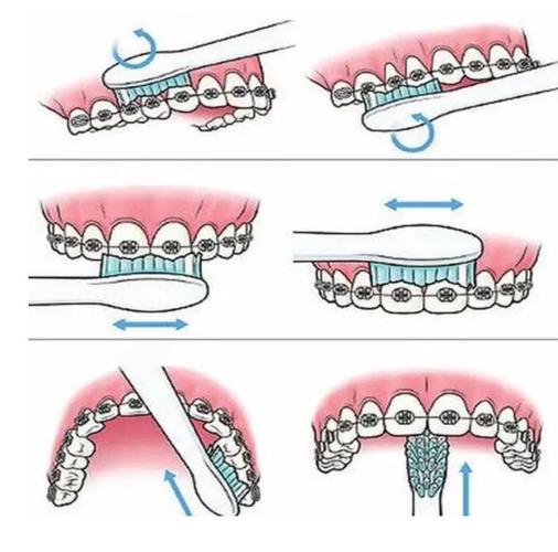 为什么正畸要刷牙-图1