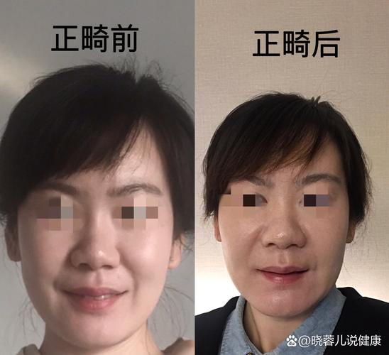 正畸中如何根据面部生长型制定干预策略？-图3