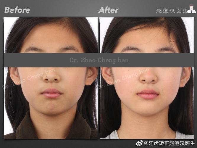 13岁正畸用口外弓有必要吗？有哪些注意事项？-图2