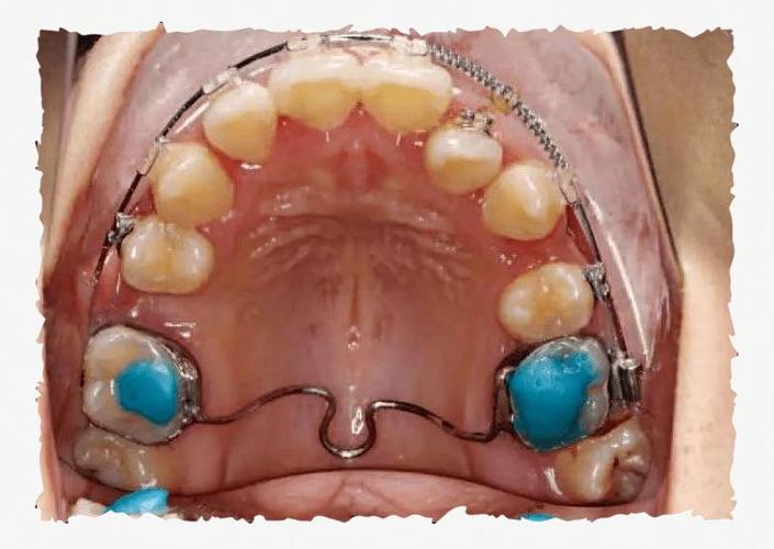 13岁正畸用口外弓有必要吗？有哪些注意事项？-图1