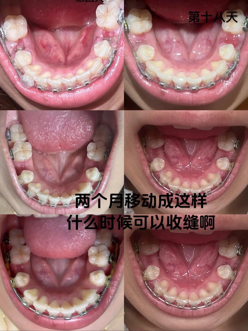 拔牙正畸后，牙齿会反弹吗？-图2