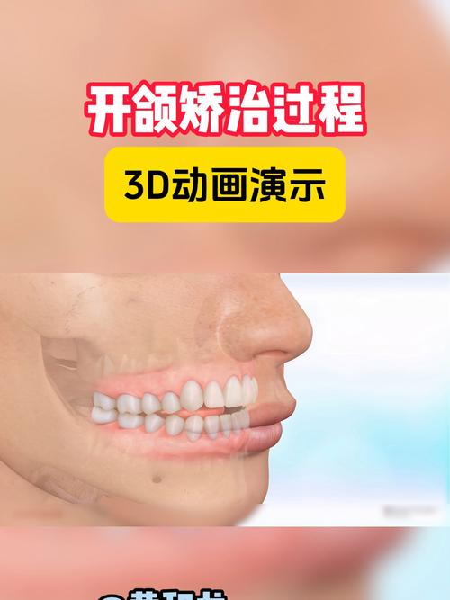口腔正畸开合,矫正视频能解答哪些疑问?-图1 口腔正畸开合,矫正视频能解答哪些疑问?-图1