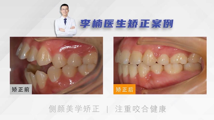 口腔正畸开合,矫正视频能解答哪些疑问?-图3 口腔正畸开合,矫正视频能解答哪些疑问?-图3