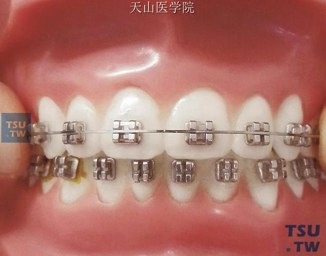 正畸方丝中点标记，如何精准定位？临床价值体现在哪？-图1