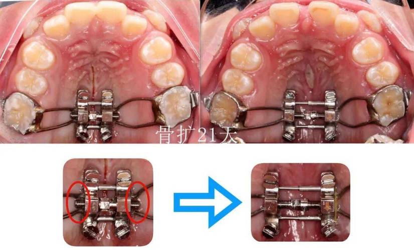 正畸片段弓是什么？它的原理、作用及适用范围具体是怎样的？-图2