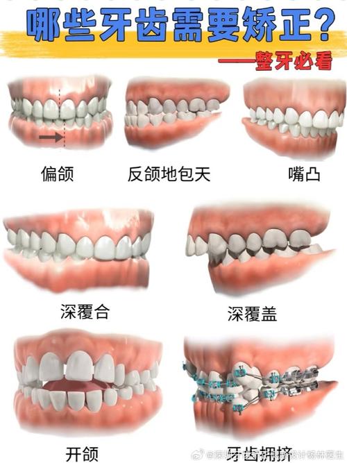 正畸骨性畸形分类的临床意义与标准是什么？-图1