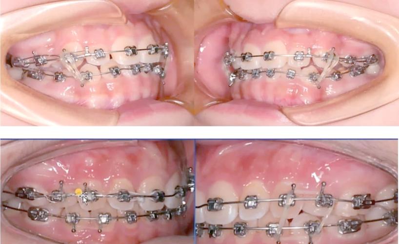 正畸前牙开合牵引如何有效进行？-图2