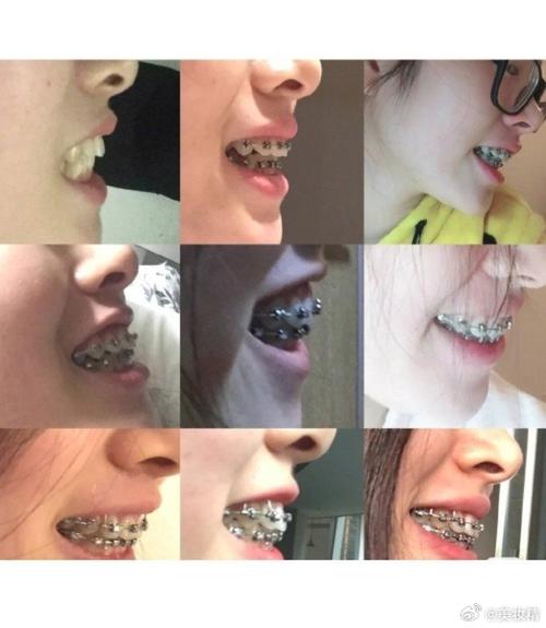 正畸下颌垫佩戴为何如此辛苦？体验者坦言有哪些难熬之处？-图1