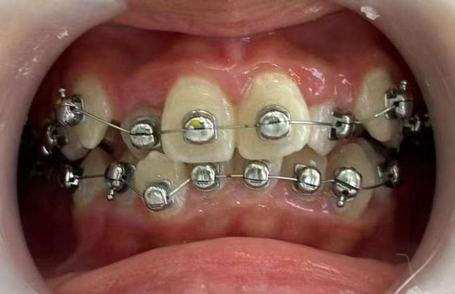 正畸拆托槽一般需要多长时间？-图3
