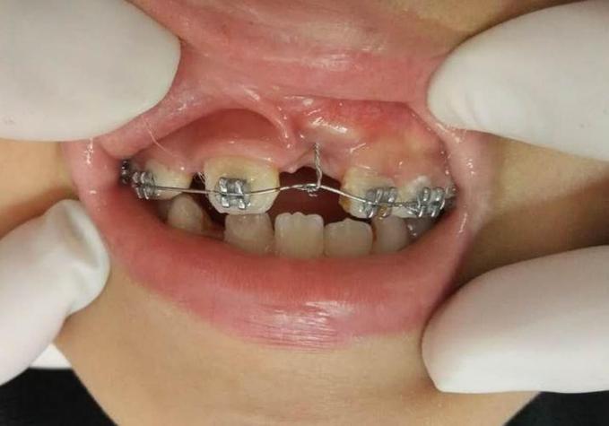 正畸j钩危害照片真实吗?是否反映实际风险?-图2 正畸j钩危害照片真实吗?是否反映实际风险?-图2