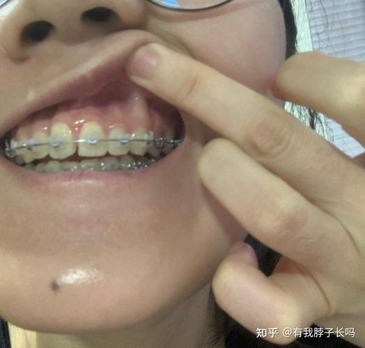 正畸j钩危害照片真实吗?是否反映实际风险?-图3 正畸j钩危害照片真实吗?是否反映实际风险?-图3