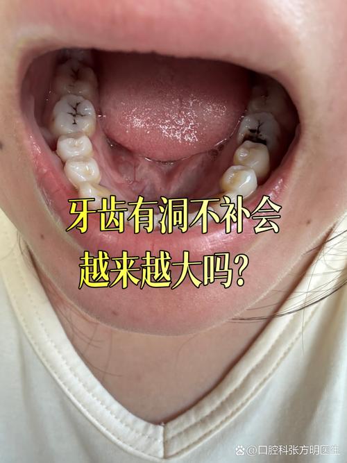 正畸过程中有蛀牙-图1