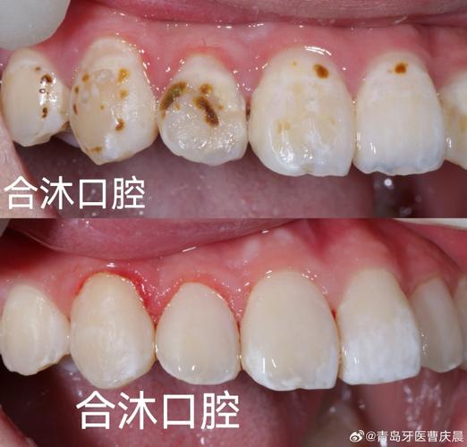 正畸过程中有蛀牙-图2