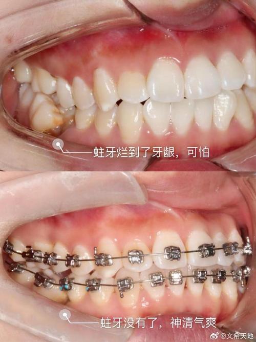 正畸过程中有蛀牙-图3