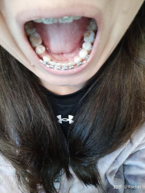 正畸博客单侧拔牙，为何这样设计？对咬合和脸型的影响大吗？-图1