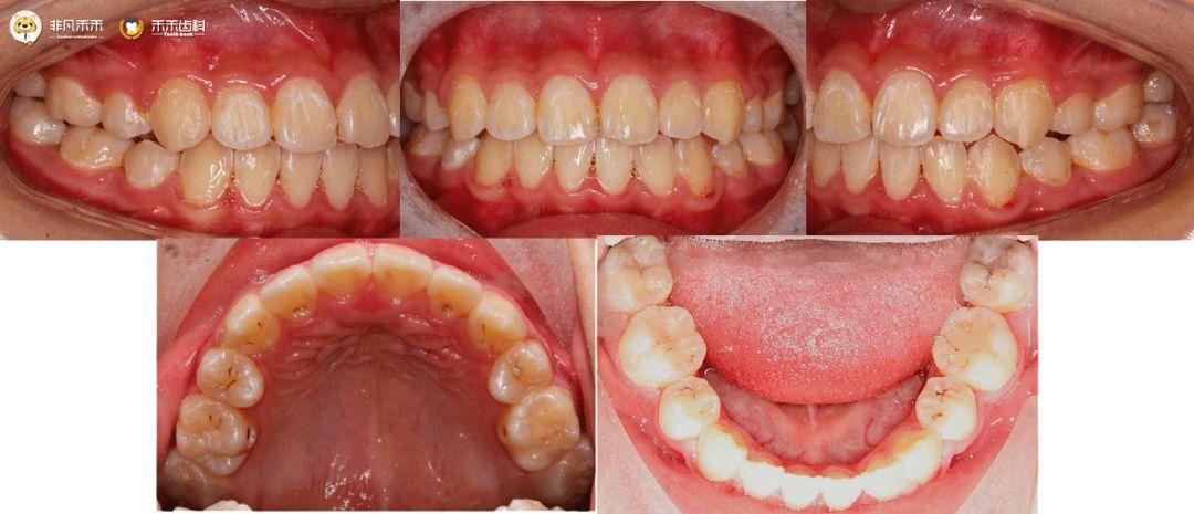 正畸博客单侧拔牙，为何这样设计？对咬合和脸型的影响大吗？-图3