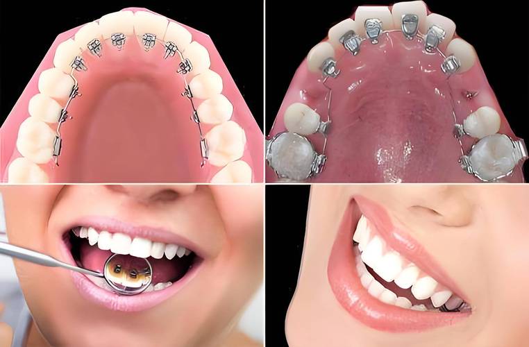 偏侧咀嚼正畸矫正-图1