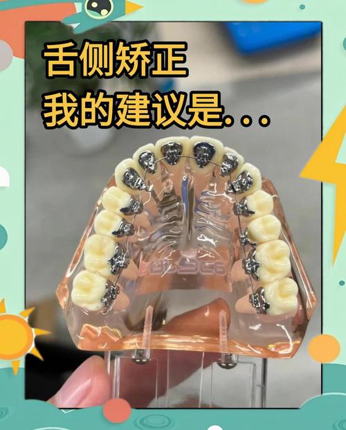 杭州舌侧正畸牙医技术如何？效果好不好？怎么选？-图1