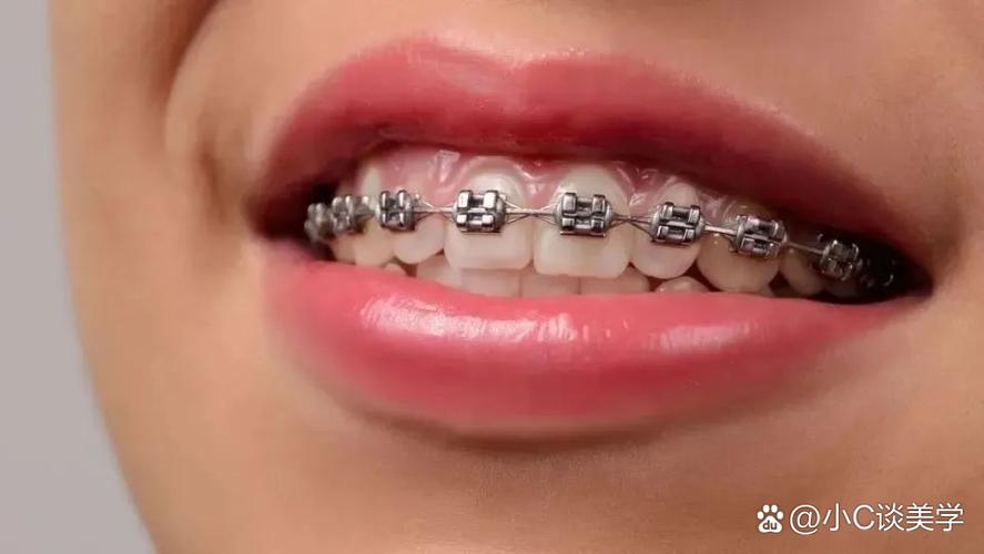 正畸大牙绞钢丝的主要作用是什么？-图1