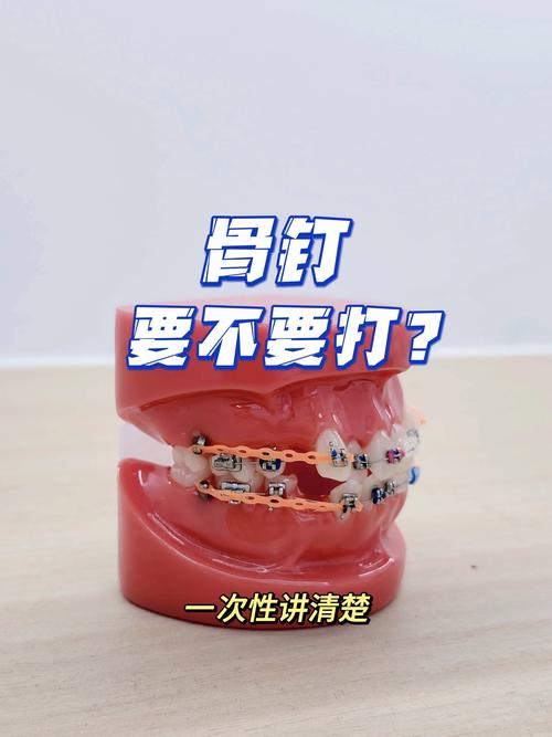 种植钉正畸官网能查到哪些关键信息？-图2