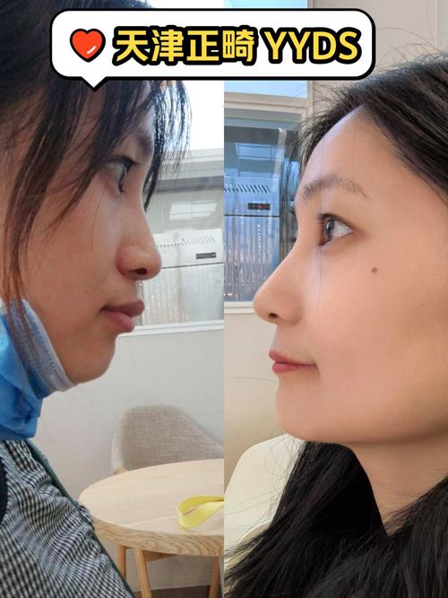 天津河西口腔正畸医院怎么选？效果好不好？价格贵不贵？-图1