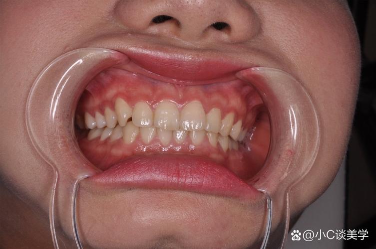 正畸后牙齿往外斜？原因分析与应对方法-图2