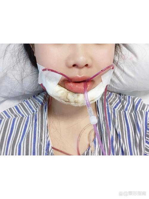 反下颌骨正畸手术能彻底解决地包天问题吗？-图2