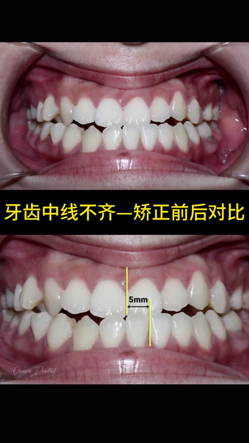 正畸调中线有哪些方法？如何精准调整与保持效果？-图1