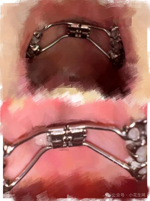 北大口腔正畸步骤流程是怎样的?包含哪些关键环节?-图1 北大口腔正畸步骤流程是怎样的?包含哪些关键环节?-图1