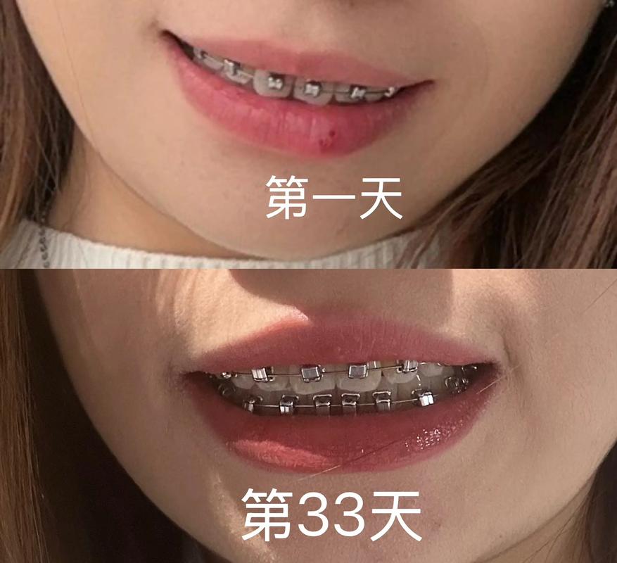 可以只正畸门牙缝-图1