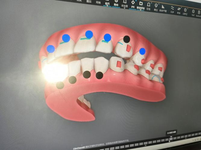 正畸个性化定制，如何根据个体差异定制？效果真的更好吗？-图2
