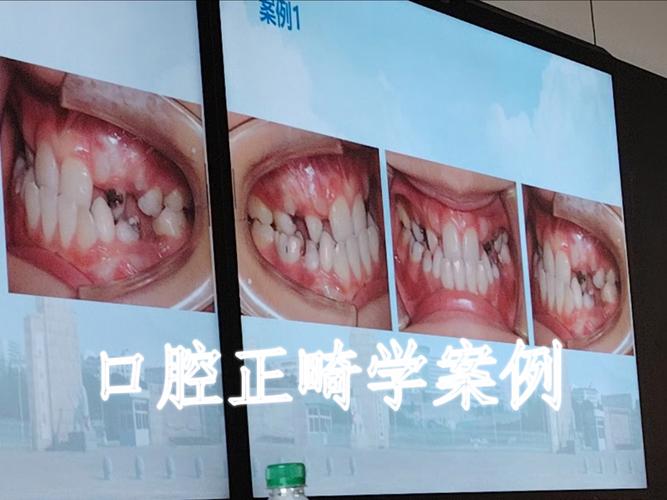 口腔正畸教学案例如何解析临床典型问题与诊疗技巧？-图2