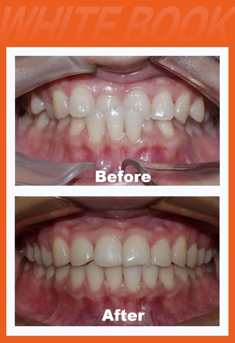 反颌正畸牙齿过程是怎样的?步骤复杂吗?周期多久?-图1 反颌正畸牙齿过程是怎样的?步骤复杂吗?周期多久?-图1