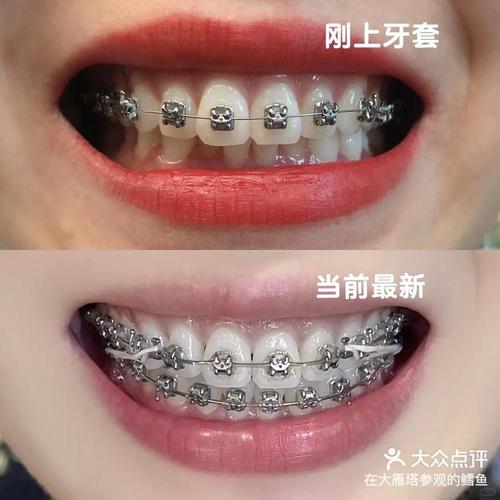 自锁牙正畸视频能看懂哪些矫正关键细节？-图2