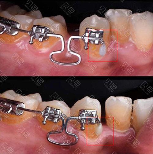 正畸钢丝末端回弯-图1